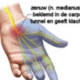 Foto van Carpal tunnel syndroom