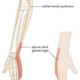 Foto van Cubitaal tunnel syndroom